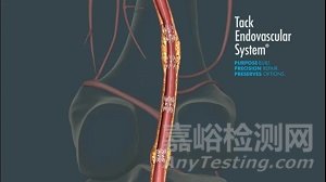 (Philips)飞利浦3.6亿美金收购Intact Vascular：扩大外周产线，挑战介入格局