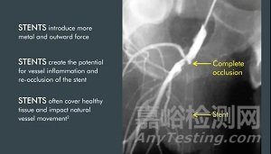 (Philips)飞利浦3.6亿美金收购Intact Vascular：扩大外周产线，挑战介入格局