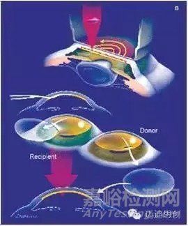 国产人工角膜6月用于临床,超全的人工角膜研发科普贴