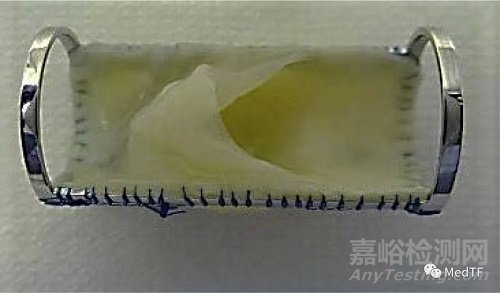 VenoValve：有望解决下肢慢性静脉功能不全患者长期困扰