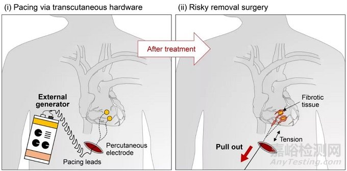 史上首个瞬时起搏器诞生！自动无害降解