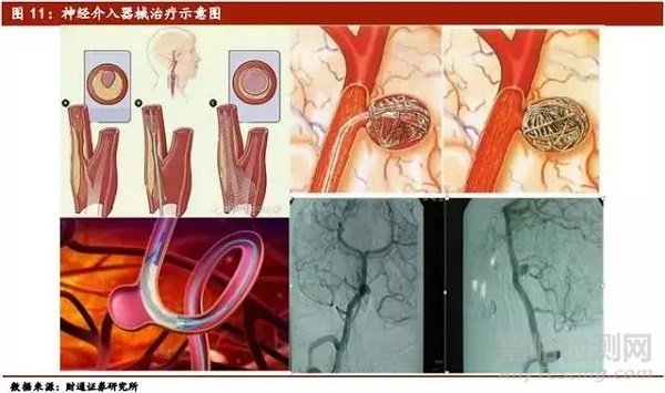 医疗介入器械行业深度报告