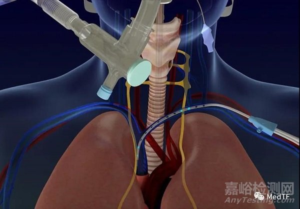 Lungpacer DPT ：机械通气新方法