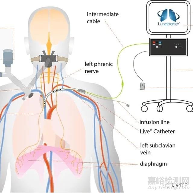 Lungpacer DPT ：机械通气新方法