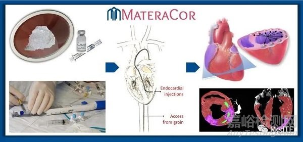 TCMR：心肌注入水凝胶治疗心衰