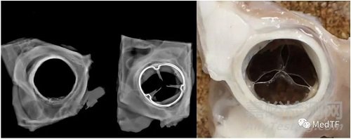 Tria：首款自动化生产的主动脉瓣膜即将登陆亚洲