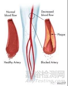 Vibrato：可穿戴超声 允许患者在家中治疗PAD