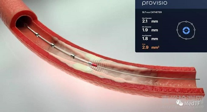 SLT IVUS：具有声呐功能IVUS 实时提供血管流腔尺寸