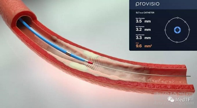 SLT IVUS：具有声呐功能IVUS 实时提供血管流腔尺寸