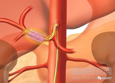 iRF Denervation：开启去交感神经治疗糖尿病研究