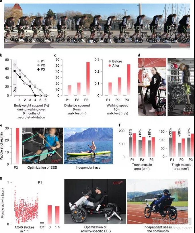 ONWARD脊髓电刺激：术后一天内即可让瘫痪患者（脊髓损伤）重新独立行走