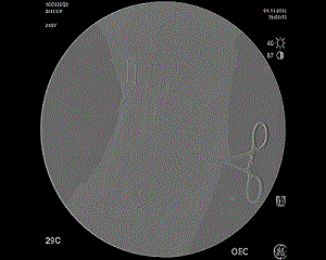 生物静脉瓣VenoValve：公布FIM长期临床结果 30月反流平均改善为 55%