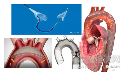 Sentinel：收集所有低风险 TAVR 患者术中碎片