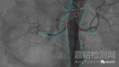 Cydar EV Mpas ：美敦力、飞利浦相中的“手术导航地图”