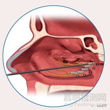 RhinAer：温控射频消融治疗慢性鼻炎 显示出长期有效