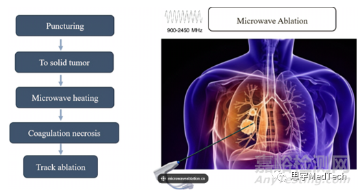 肿瘤消融技术7大核心技术