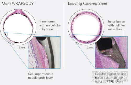 Wrapsody：不透细胞的覆膜支架 避免/减少再狭窄