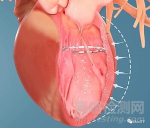 AccuCinch：首款经皮修复心室治疗心衰器械获FDA授予“突破性设备”称号