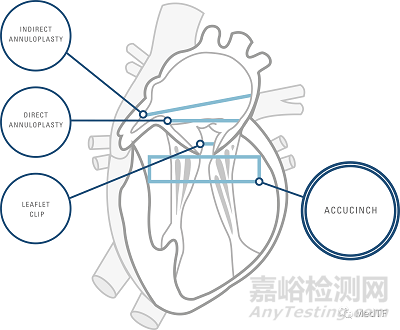 AccuCinch：首款经皮修复心室治疗心衰器械获FDA授予“突破性设备”称号