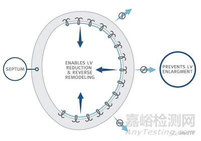 AccuCinch：首款经皮修复心室治疗心衰器械获FDA授予“突破性设备”称号