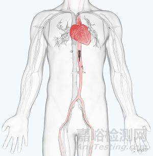 ModulHeart：允许叠加经皮管心脏泵的完成首次人体研究