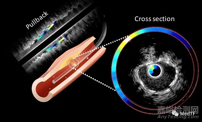 I3 NIRF-IVUS：近红外光谱和超声二合一血管造影导管