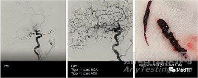 TIGERTRIEVER13：最小取栓支架获FDA批准上市