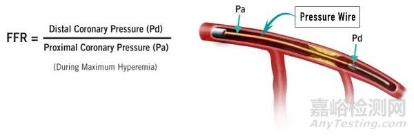 冠脉血管疾病的三大评估器械：IVUS、OCT、FFR
