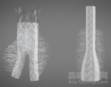 Kardiozis：带绒毛的AAA覆膜支架 解决EVARⅡ型内漏