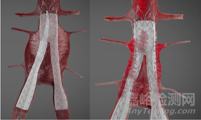 Kardiozis：带绒毛的AAA覆膜支架 解决EVARⅡ型内漏