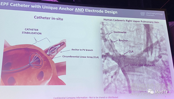 EPF Catheter：具有锚定功能的PFA导管 实现“一次性消融”