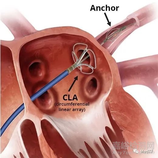 EPF Catheter：具有锚定功能的PFA导管 实现“一次性消融”