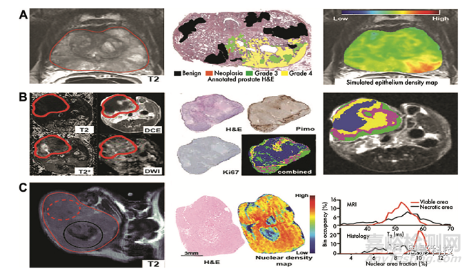 Radiology：影像组学特征的生物学意义