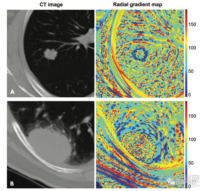 Radiology：影像组学特征的生物学意义