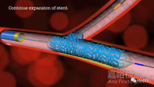 ABS：分叉的冠脉支架