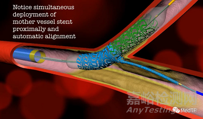 ABS：分叉的冠脉支架