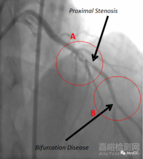 ABS：分叉的冠脉支架