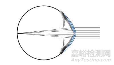 现代巩膜镜的设计特点及临床应用