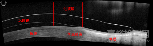 现代巩膜镜的设计特点及临床应用