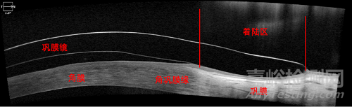 现代巩膜镜的设计特点及临床应用