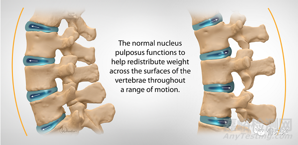 全球唯一！腰椎髓核置换系统开展临床试验