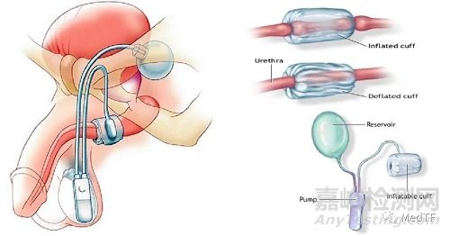 UroActive：智能化人工尿道括约肌