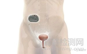 UroActive：智能化人工尿道括约肌