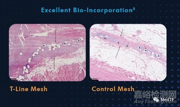 T-Line Hernia Mesh：具有缝合功能的疝气补片