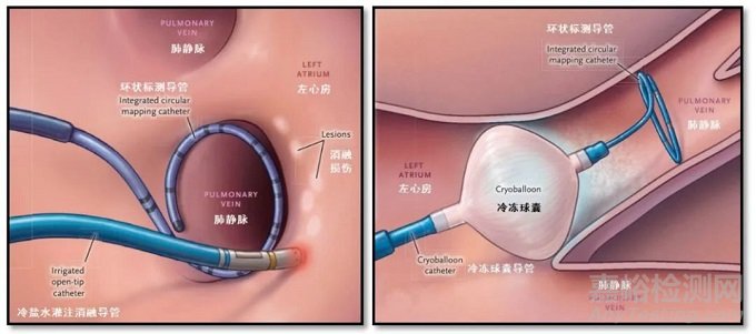 上海康沣生物冷冻消融技术获美国FDA认定