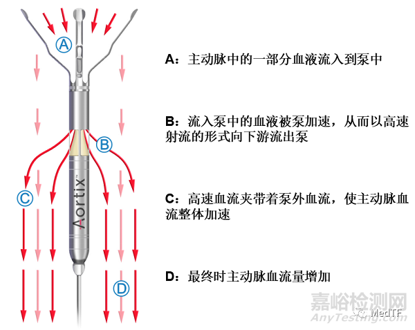 Aortix: 研究显示介入泵能够快速缓解充血