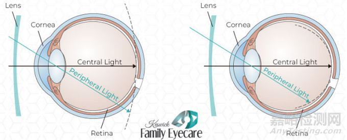 延缓近视眼镜片获FDA突破性设备认定