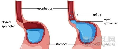 强生胃反流治疗磁珠获批FDA