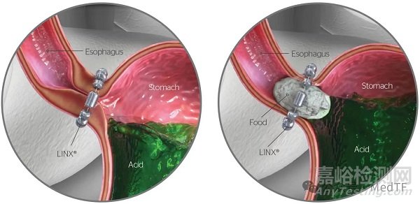 强生胃反流治疗磁珠获批FDA