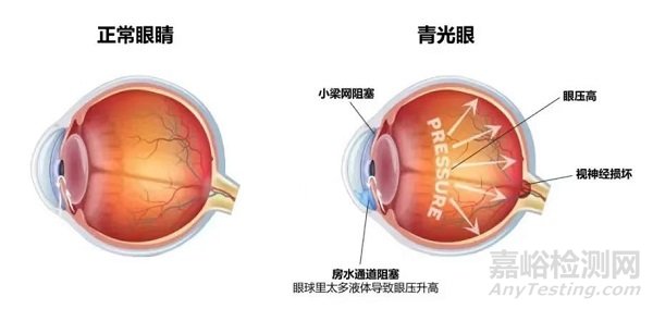 全球首款青光眼飞秒激光器获批CE